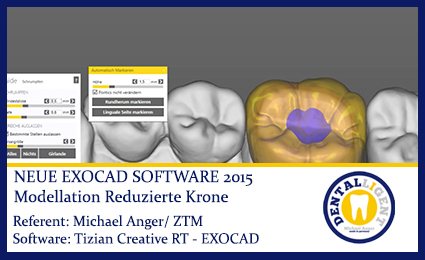 Product image of the product “2015-Modelling reduzed Crown - Exocad 2015 ”