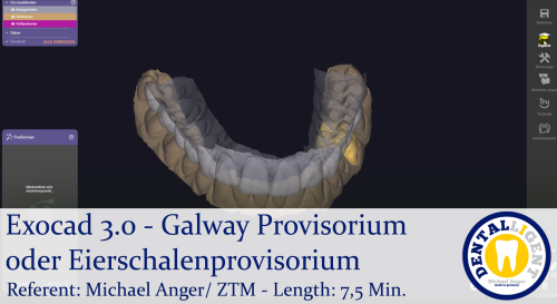 Product image of the product “2021-Exocad 3.0 – Galway Provisorium oder Eierschalenprovisorium ”