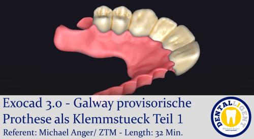 Product image of the product “2021-Exocad 3.0 – Galway provisorische Prothese als Klemmstueck Teil 1 ”