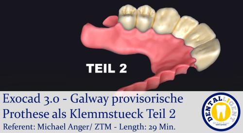 Product image of the product “2021-Exocad 3.0 – Galway provisorische Prothese als Klemmstueck Teil 2 ”