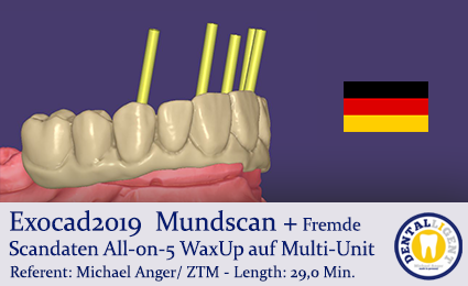 Product image of the product “2019 - Exocad  Mundscan + Fremde Scandaten All-on-5 WaxUp auf Multi-Unit ”