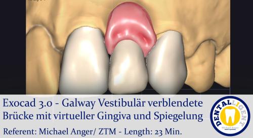 Product image of the product “2021-Exocad 3.0 – Galway Vestibulär verblendete Brücke mit virtueller Gingiva und Spiegelung ”