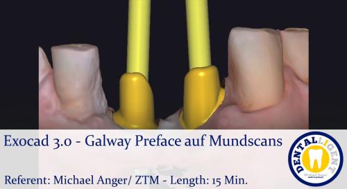 Product image of the product “2021-Exocad 3.0 – Galway Preface auf Mundscans ”