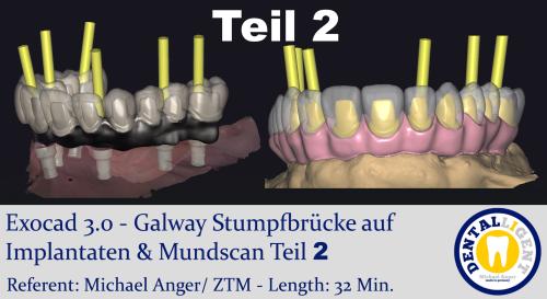 Product image of the product “2021-Exocad 3.0 – Galway Stumpfbrücke auf Implantaten & Mundscan Teil 1 ”