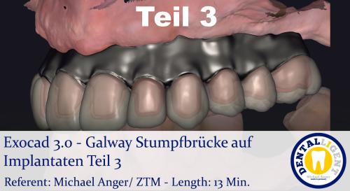 Product image of the product “2021-Exocad 3.0 – Galway Stumpfbrücke auf Implantaten & Mundscan Teil 3 ”