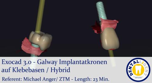 Product image of the product “2021-Exocad 3.0 – Galway Implantatkronen auf Klebebasen / Hybrid ”