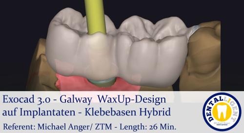 Artikelbild des Artikels “2021-Exocad - Exocad 3.0 – GalwayWaxUp-Design auf Implantaten - Klebebasen Hybrid “