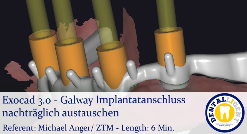 Product image of the product “2021-Exocad 3.0 – Galway Implantatanschluss nachträglich austauschen ”