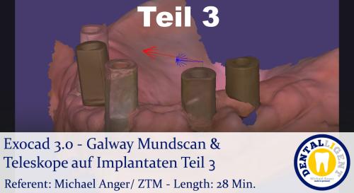 Artikelbild des Artikels “2021-Exocad - Exocad 3.0 - Galway Mundscan & Teleskope auf Implantaten Teil 3 “
