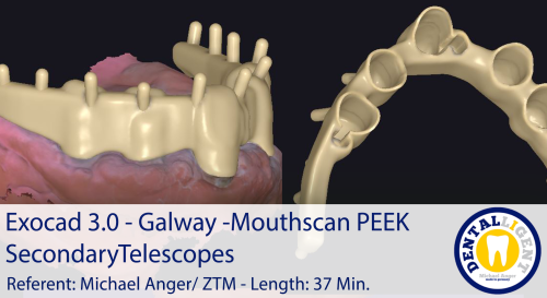 Product image of the product “2021-Exocad 3.0 – Galway  Mouthscan PEEK Secondary Telescopes ”