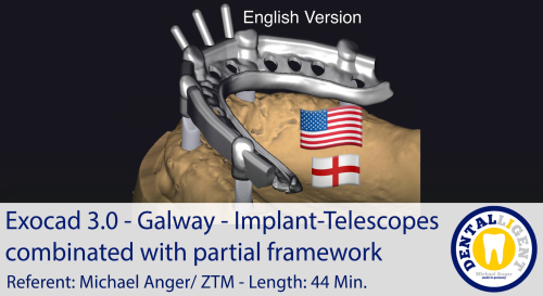 Product image of the product “2021-Exocad 3.0 – Galway Implant-Telescopes combinated with partial framework ”