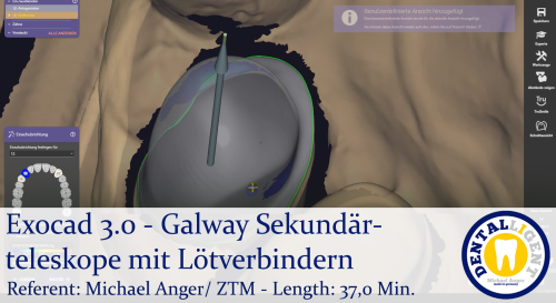 Product image of the product “2021-Exocad 3.0 - Galway Sekundärteleskope mit Lötverbindern ”