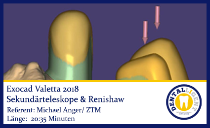 Product image of the product “2018-Exocad-Valetta-Sekundärteleskope & Renishaw ”