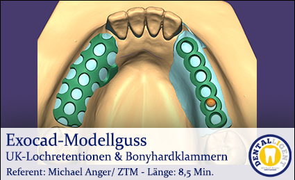 Product image of the product “2019-Exocad-Modellguss UK-Lochretentionen & Bonyhardklammern ”