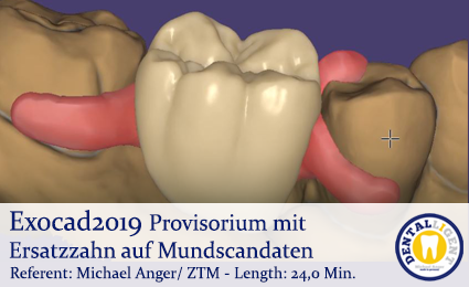 Product image of the product “Exocad2019  - Provisorium mit Ersatzzahn auf Mundscandaten ”