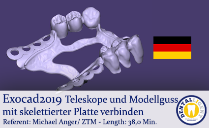 Product image of the product “Exocad2019  - Connecting telescopes and cast model with skeletal plate ”