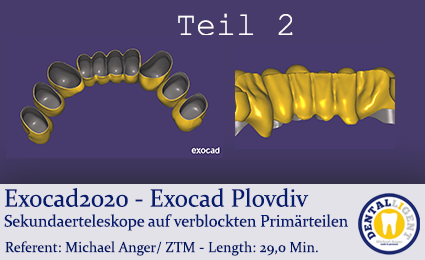 Product image of the product “2020-Exocad -Exocad Plovdiv - Sekundaerteleskope auf verblockten Primärteilen - Teil 2 mit Anatomie ”