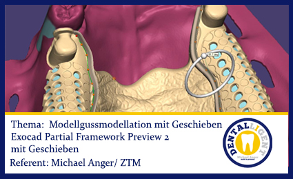 Product image of the product “2016-FREE VIDEO! - EXOCAD 2016 - Modellgussmodellation mit Geschieben ”