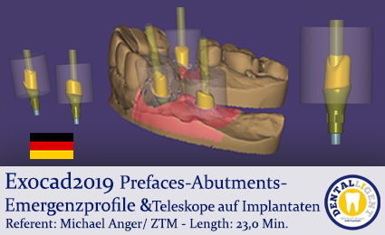 Product image of the product “Exocad2019  -Prefaces-Abutments-Emergenzprofile &Teleskope auf Implantaten ”