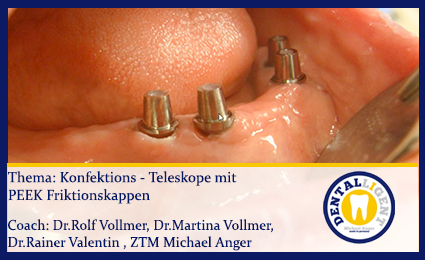 Product image of the product “GRATIS - Konfektions - Teleskope mit PEEK Friktionskappen ”