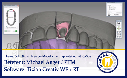 Product image of the product “Schnittansichten bei Modellation einer Implantatkrone mit Renishaw-Scan ”