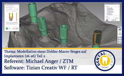 Product image of the product “Modellation eines Dolder-Macro-Steges auf Implantaten (16-26) Teil 2 ”