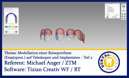 Product image of the product “Modellation einer Reiseprothese (Ersatzprothese) auf Teleskopen und Implantaten - Teil 2 ”