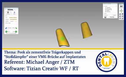 Product image of the product “Peek als zementfreie Trägerkappen und “Stoßdämpfer“ einer VMK-Brücke auf Implantaten ”