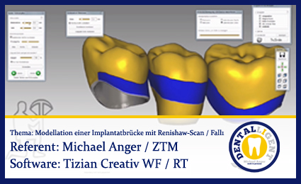 Product image of the product “Modellation einer Implantatbrücke mit Renishaw-Scan / Fall1 ”
