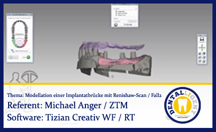 Product image of the product “Modellation einer Implantatbrücke mit Renishaw-Scan / Fall2 - Teil 1 ”