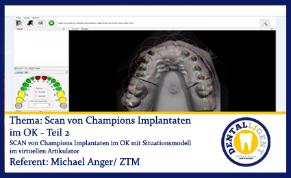 Artikelbild des Artikels “Scan von Champions Implantaten im OK - Teil 2 “