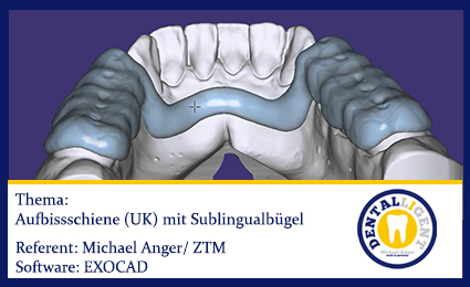 Product image of the product “2016-EXOCAD - Aufbissschiene (UK) mit Sublingualbügel ”