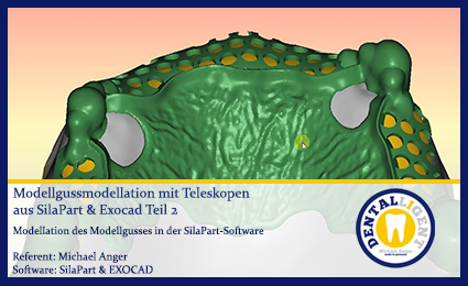 Product image of the product “Modellgussmodellation mit Teleskopen aus SilaPart & Exocad Teil 2 ”