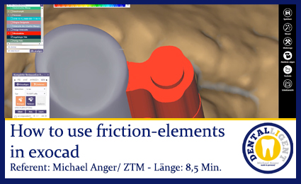 Product image of the product “Exocad-2019 TK-Soft  friction-elements in exocad to get adjustable telescopes. ”