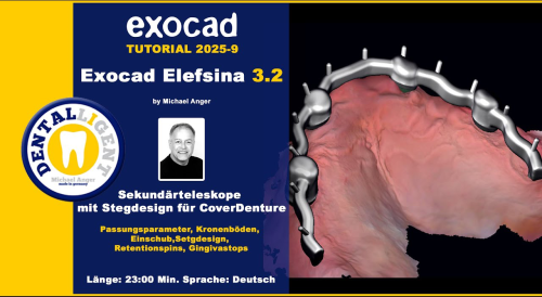 Product image of the product “Exocad Elefsina 3.2 - 2025-9 - Sekundärteleskope mit Stegdesign für CoverDenture ”