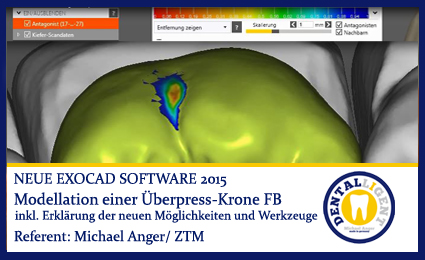 Product image of the product “Modellation Überpresskronen ”