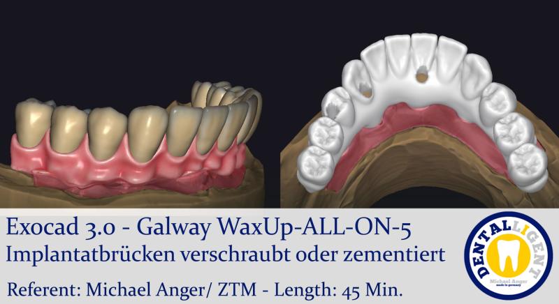 Product image 1 of the product “2021-Exocad 3.0 – Galway WaxUp-ALL-ON-5 Implantatbrücken verschraubt oder zementiert ”