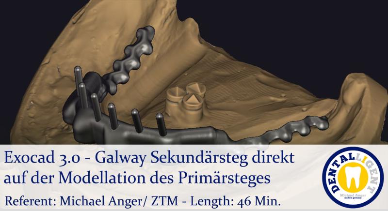 Product image 1 of the product “2021-Exocad 3.0 – Galway Sekundärsteg direkt auf der Modellation des Primärsteges ”