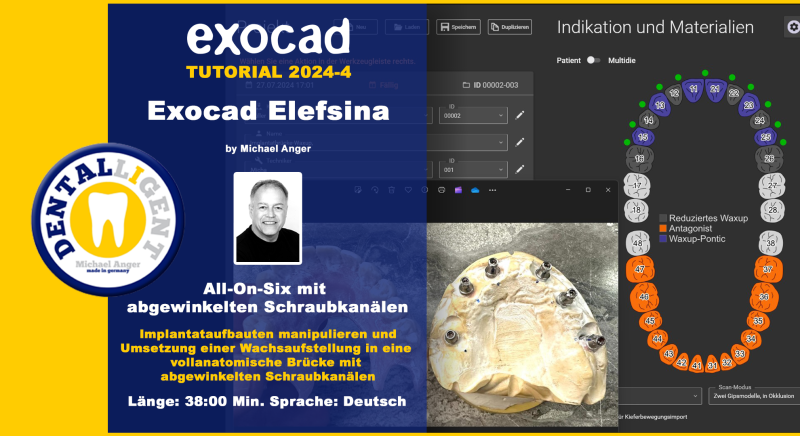 Product image 1 of the product “Exocad Elefsina 2024-4 All-On-Six mit abgewinkelten Schraubkanälen ”