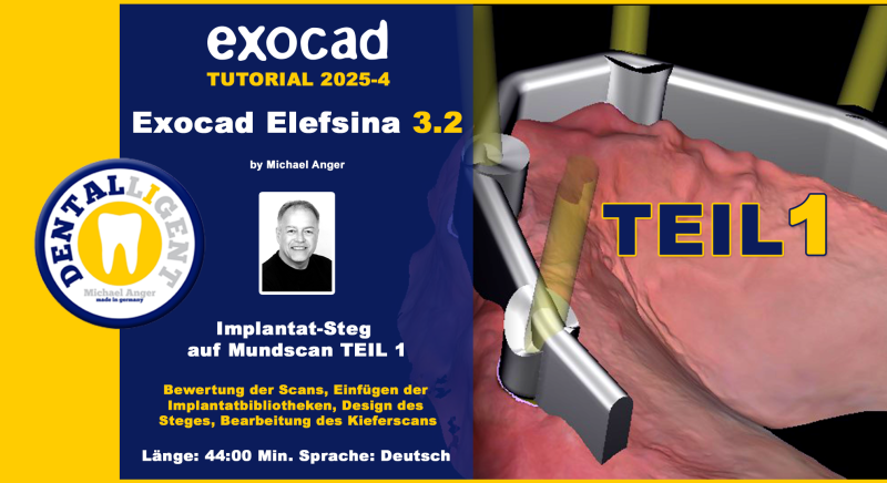 Product image 1 of the product “Exocad Elefsina 3.2 -2025-4 -Implantat Steg auf Mundscan Teil 1 ”