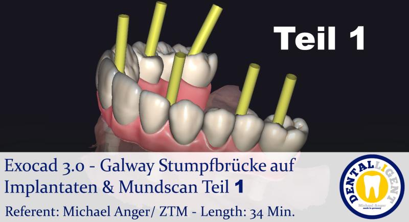 Artikelbild 1 des Artikels “2021-Exocad - Exocad 3.0 – Galway Stumpfbrücke auf Implantaten & Mundscan Teil 1 “