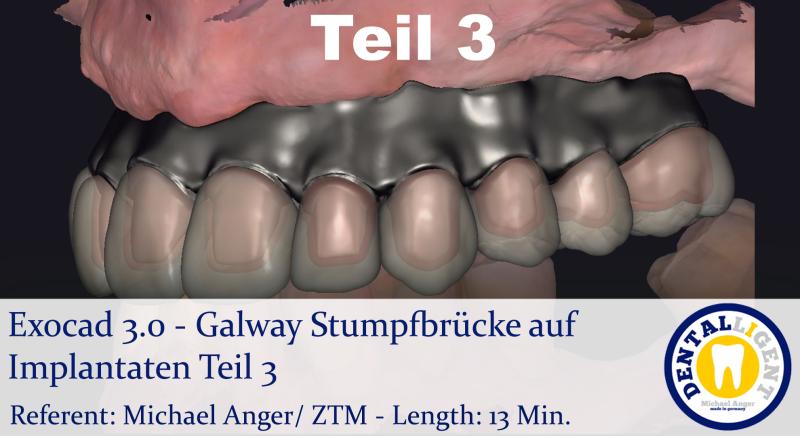 Artikelbild 1 des Artikels “2021-Exocad - Exocad 3.0 – Galway Stumpfbrücke auf Implantaten & Mundscan Teil 3 “
