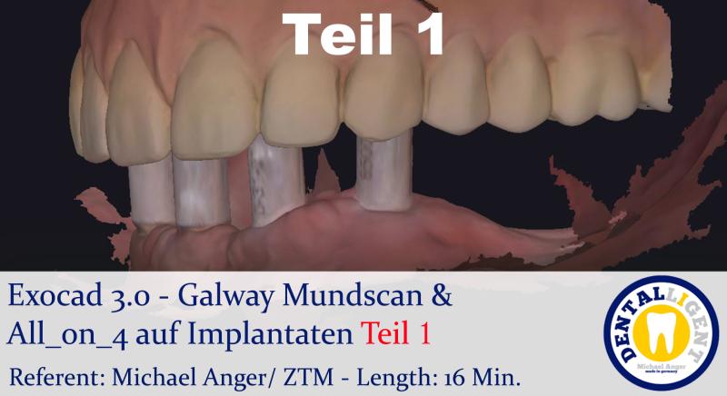Product image 1 of the product “2021-Exocad 3.0 – Galway Mundscan & All_on_4 auf Implantaten Teil1 ”
