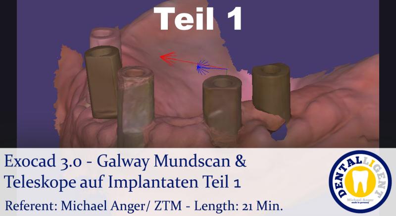 Product image 1 of the product “2021-Exocad 3.0 - Galway Mundscan & Teleskope auf Implantaten Teil1 ”
