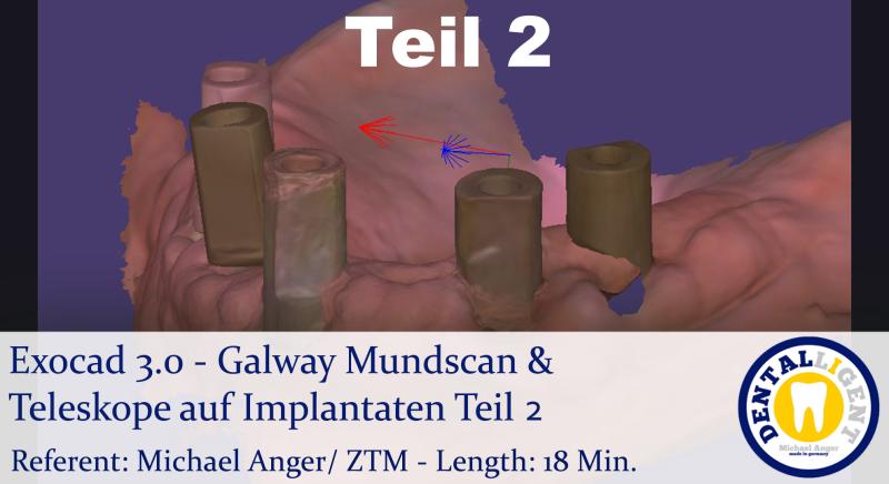 Product image 1 of the product “2021-Exocad 3.0 - Galway Mundscan & Teleskope auf Implantaten Teil1 ”