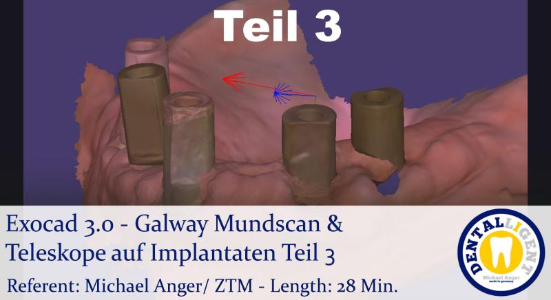 Product image 1 of the product “2021-Exocad 3.0 - Galway Mundscan & Teleskope auf Implantaten Teil3 ”