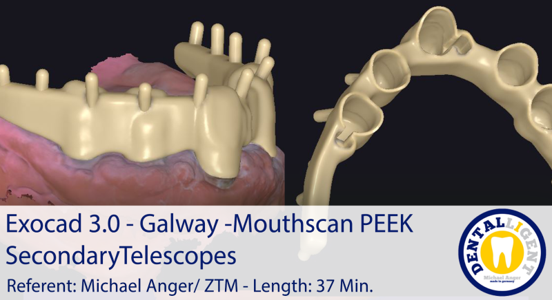 Product image 1 of the product “2021-Exocad 3.0 – Galway  Mouthscan PEEK Secondary Telescopes ”
