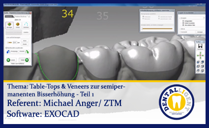 Product image 1 of the product “Table-Tops & Veneers zur semipermanenten Bisserhöhung Teil 1 ”