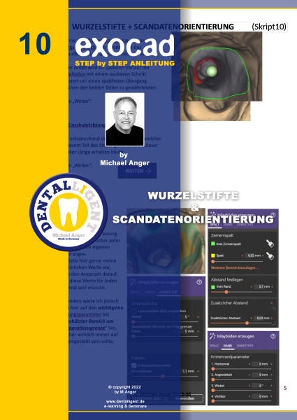 Artikelbild 1 des Artikels “Exocad Step by Step Anleitung - Nr. 10 - Wurzelstifte & Scandatenorientierung “