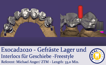 Product image 1 of the product “Exocad 2020 - Sekundärteleskope mit dem Stegmodul ”